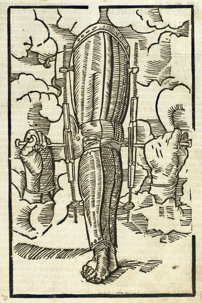Illustration showing a leg being straightened with rods.